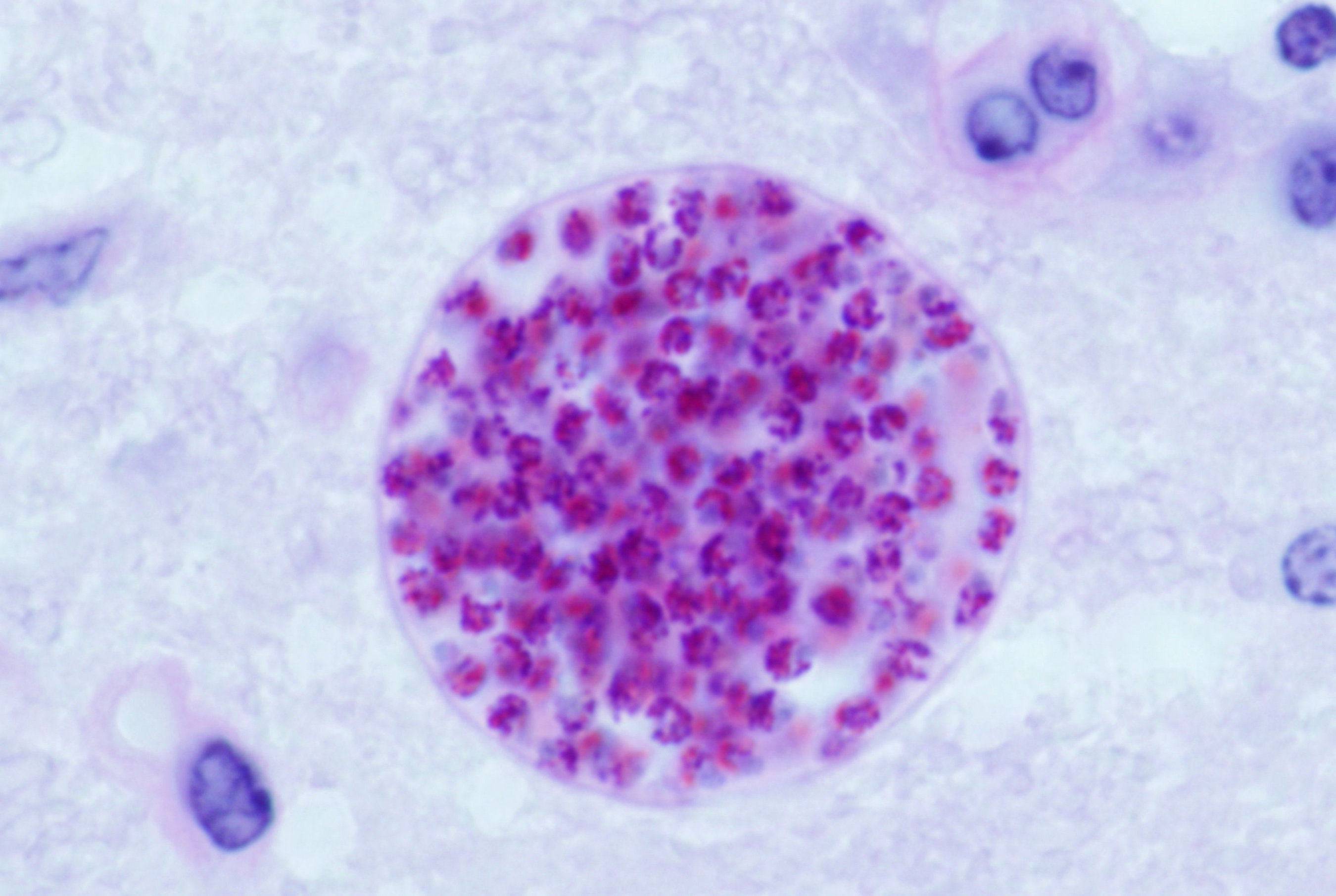Toxoplasmosis